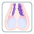 Varicocele Embolization